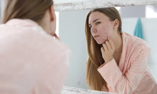 Tratamentos para Acne: O Que um Dermatologista Recomenda